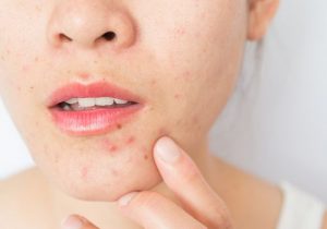 7 step acne treatment at Grace Skincare Clinic with Dr Hun Kim Thao