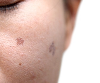 Melasma and Pigmentation Disorders Treatment