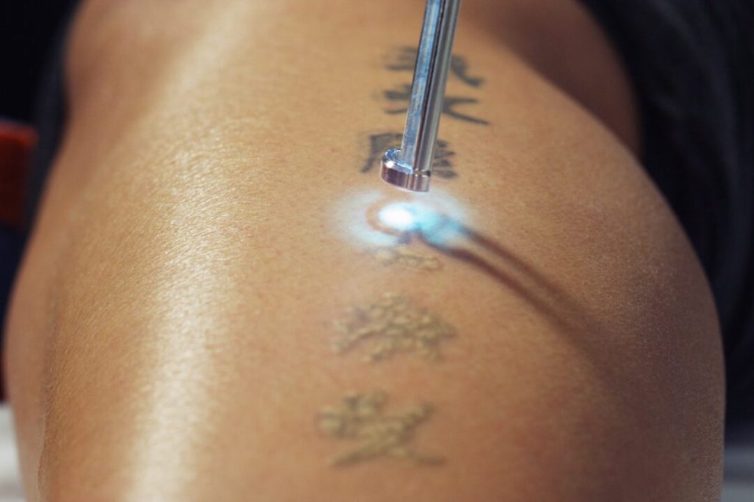 Introducing Laser Tattoo Removal! - Dr Monica Scheel Dermatology,  Kailua-Kona, HI