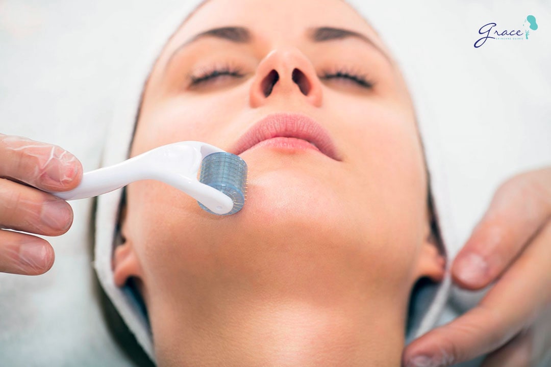 microneedling skin rejuvenation