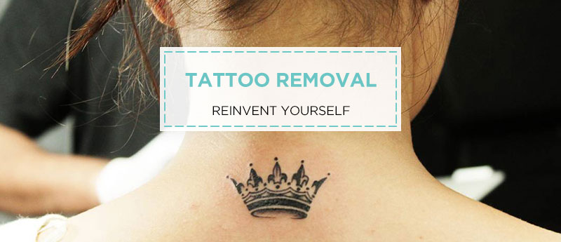 tattoo removal laser