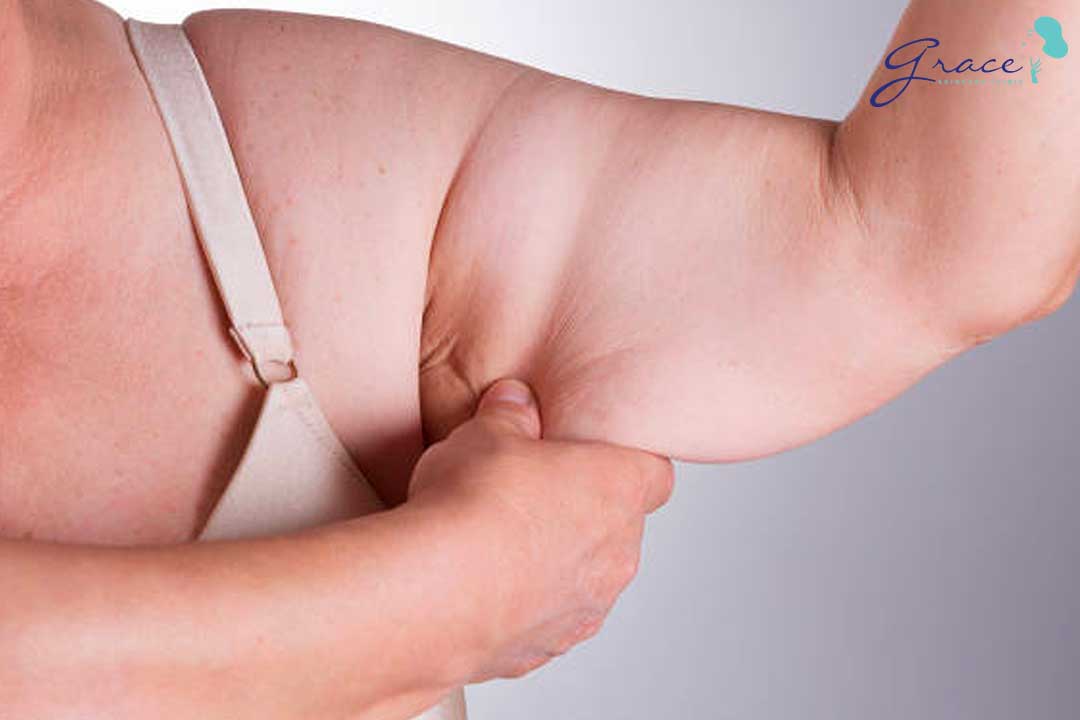 cách điều trị da sần vỏ cam