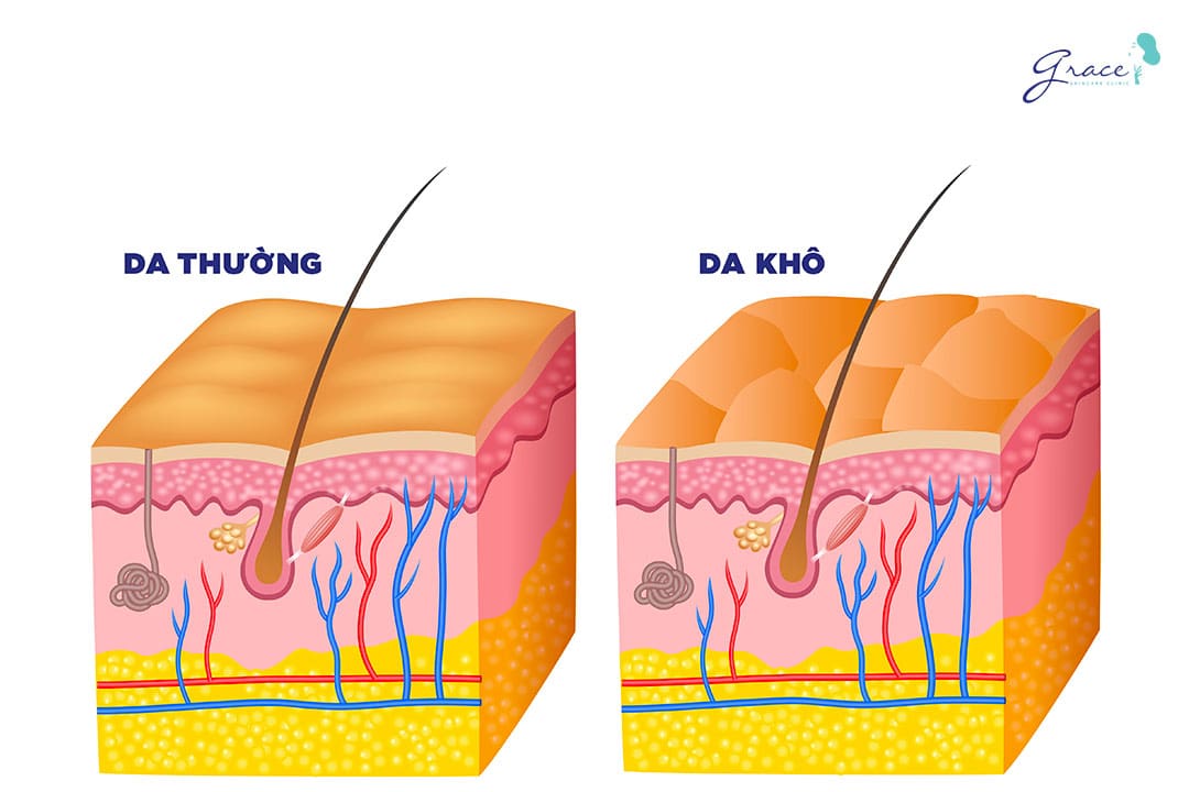 da khô dưới góc độ y khoa