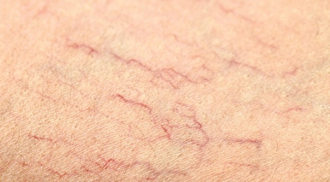 Giãn mao mạch vùng mặt với mạch máu nhỏ li ti