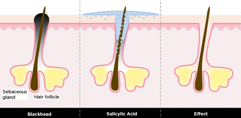 điều trị sẹo rỗ