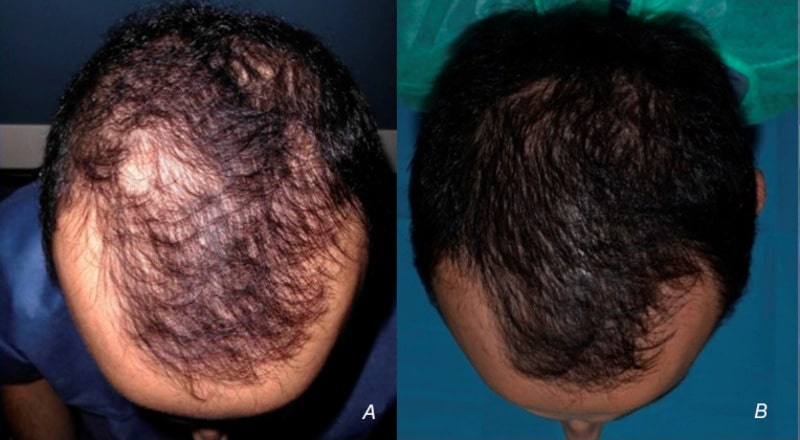 hair transplant