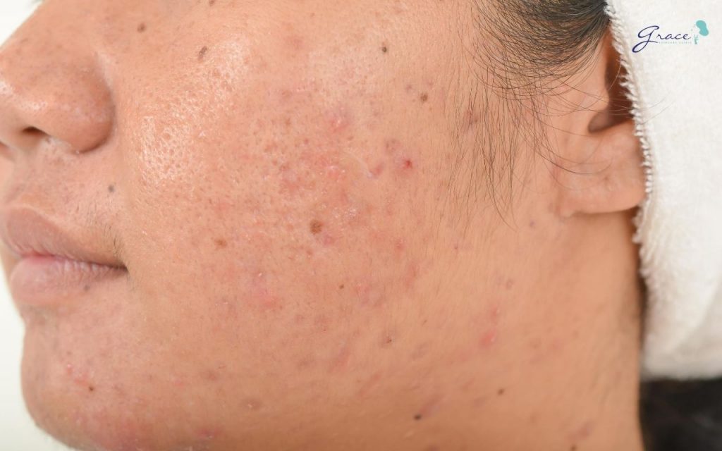 Điều trị mụn trứng cá