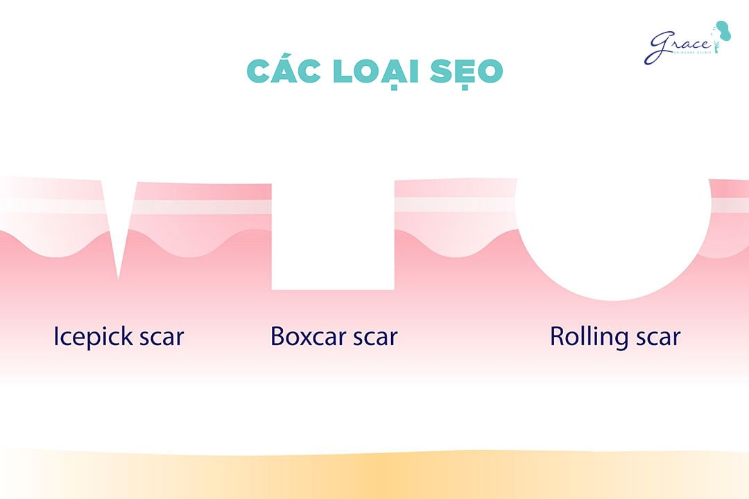 các loại sẹo