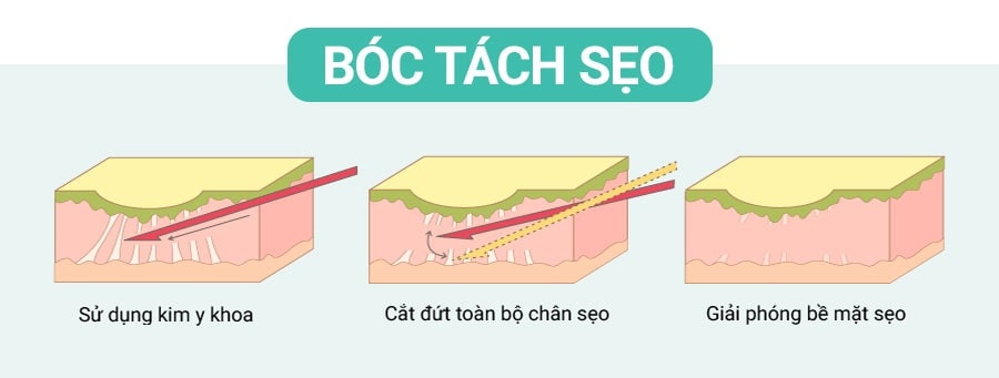 cắt đáy sẹo