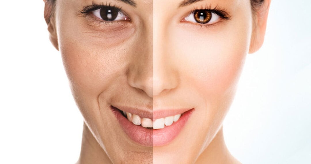 chemical peel
