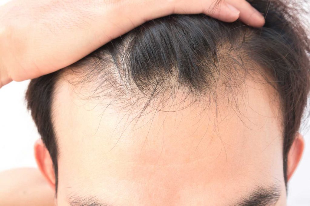 Hair Regrowth Treatment In Women And Men Grace Skincare Clinic