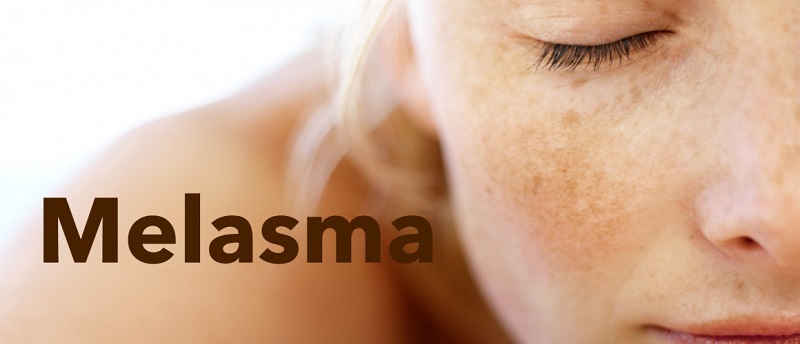 Melasma treatment - Grace Skincare Clinic