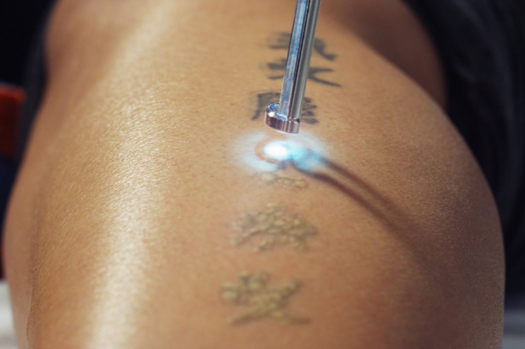 Laser tattoo removal has potential side effects