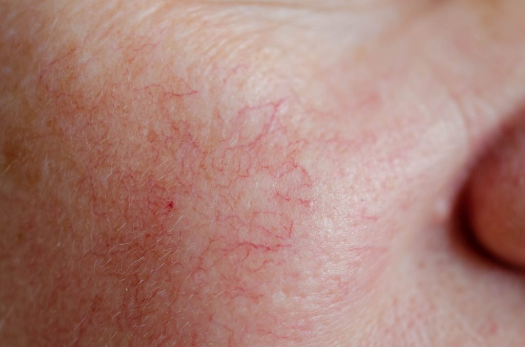 Trị da mặt mỏng nổi gân máu