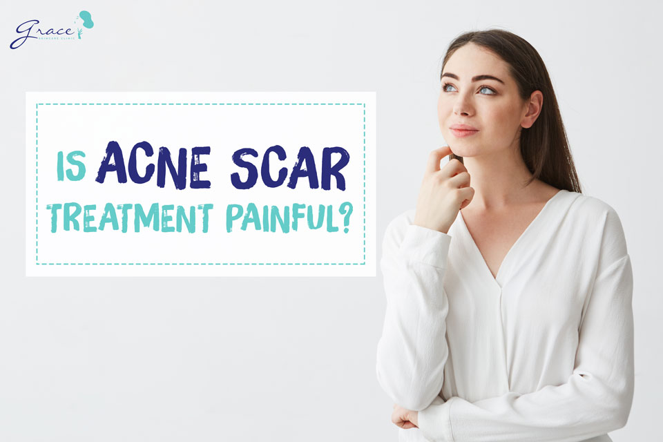 Is Acne Scar Treatment Painful