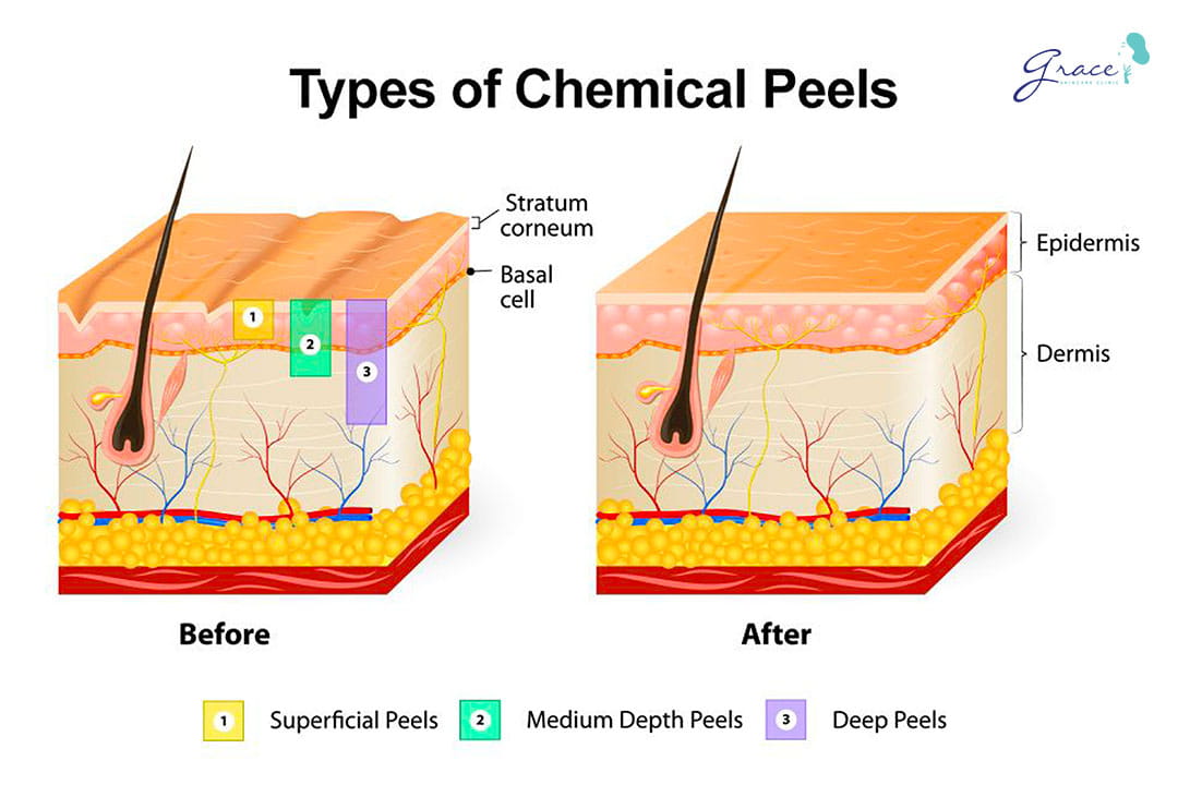 mức độ peel da trị mụn