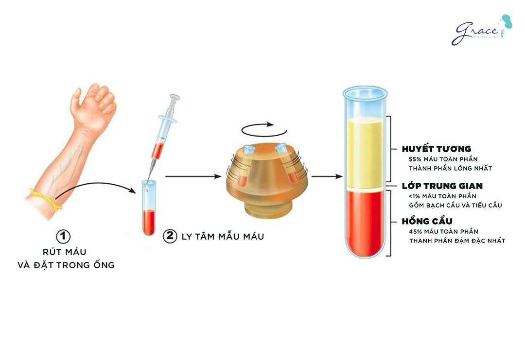 phương pháp lăn kim trị sẹo