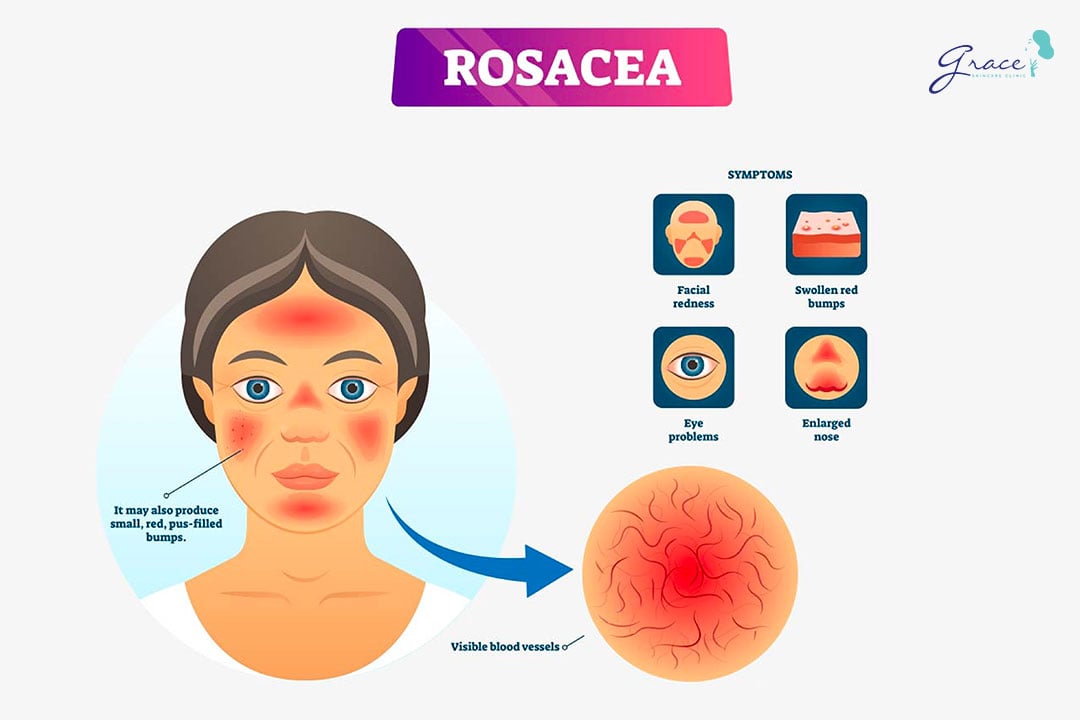 tác dụng phụ khi nhiễm corticoid