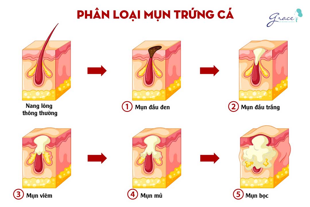 phân loại mụn trứng cá để nhận biết mụn bọc