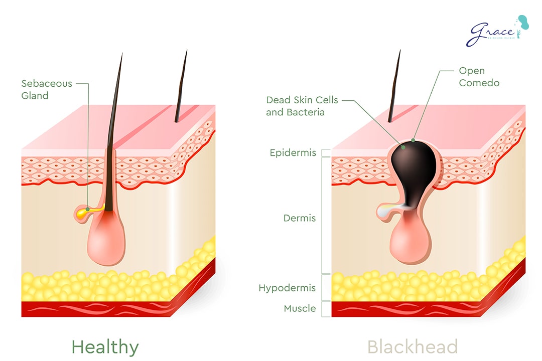 cơ chế hình thành mụn đầu đen