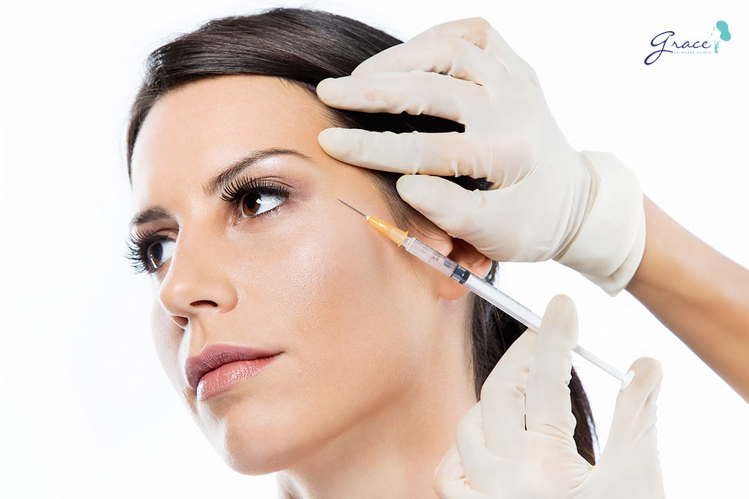 tiêm botox xóa nếp nhăn trán