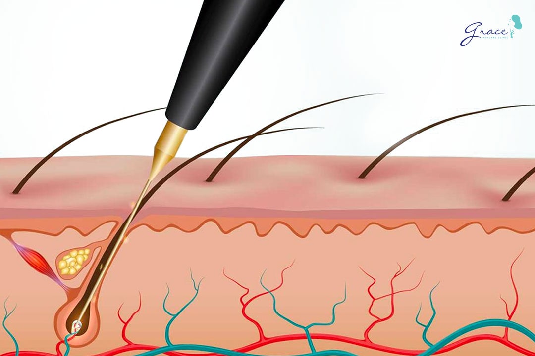 kỹ thuật đốt điện triêt lông vĩnh viễn