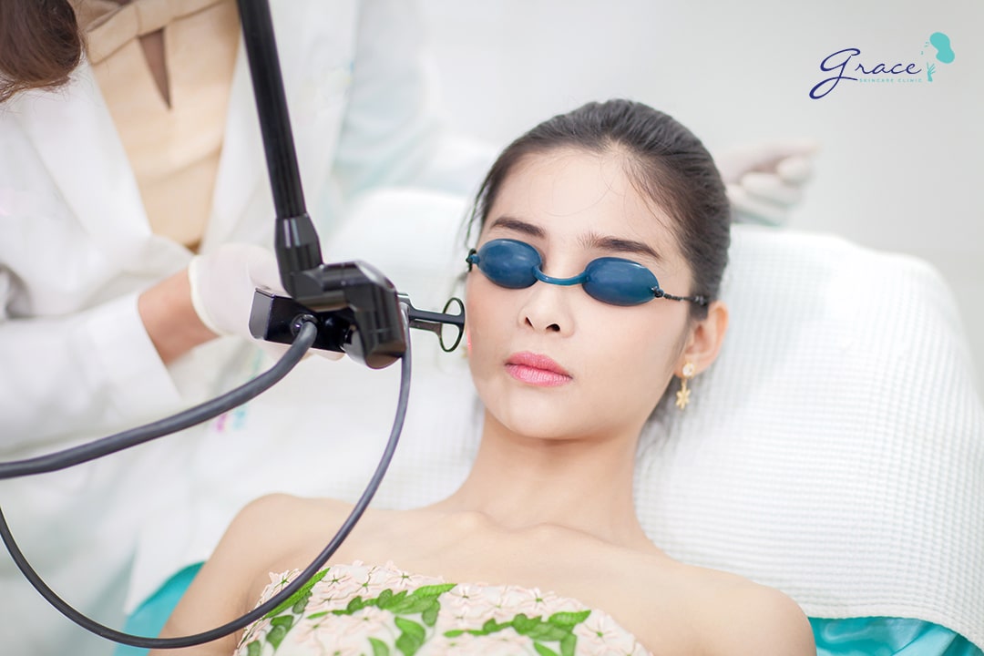 xóa xăm lông mày bằng laser