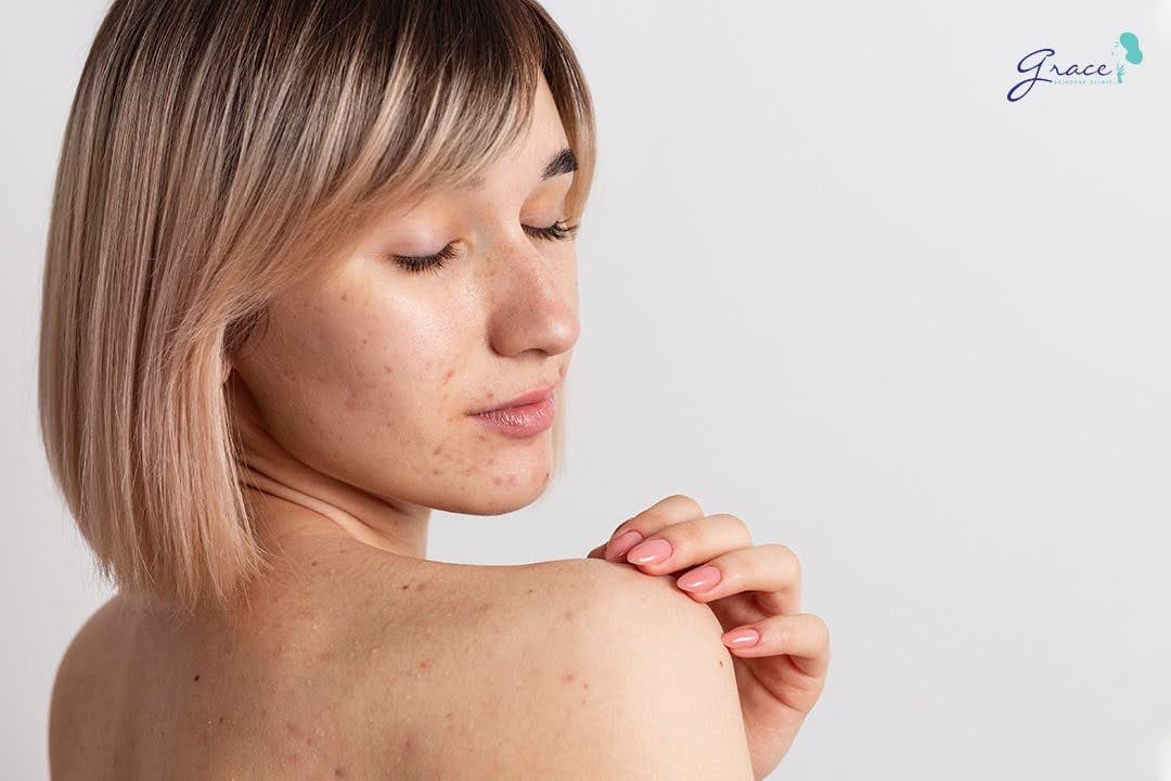Tiêu chí đánh giá nơi trị mụn hiệu quả