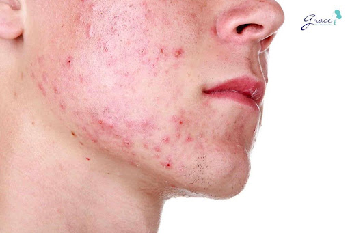 Cần tìm hiểu nguyên nhân gây mụn trứng cá mới tìm ra được cách trị mụn ở tuổi dậy thì nam