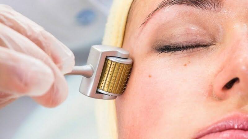 Trị sẹo rỗ an toàn hiệu quả theo lời khuyên Bác sĩ Da liễu