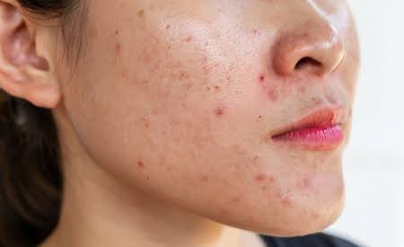 Các phương pháp điều trị mụn phổ biến