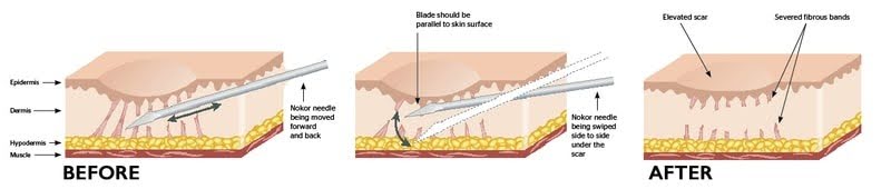 Cả 2 các phương pháp điều trị sẹo bằng bóc tách sẹo và lăn kim kết hợp đều dựa trên việc quá trình kích hoạt cơ chế tự làm lành của da bằng việc tạo ra các vi tổn thương