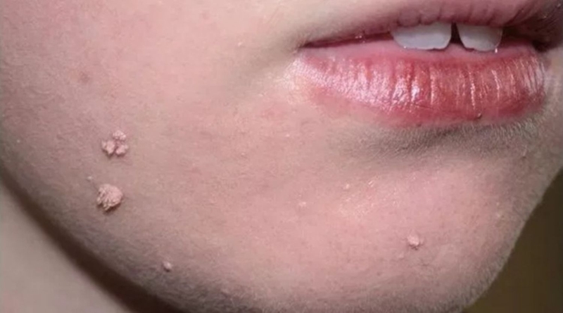 Mụn cóc dạng sợi mảnh là tình trạng da tăng sinh lành tính với tốc độ phát triển khá nhanh, gây ảnh hưởng trực tiếp đến thẩm mỹ khuôn mặt.