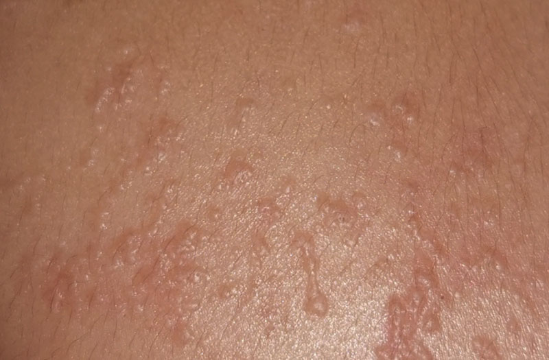 Mụn cóc phẳng là dạng tổn thương da nhỏ lành tính, có kích thước mỏng nhẹ và khó phát hiện ngay từ giai đoạn đầu.