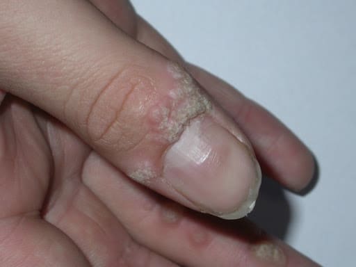 Mụn cóc quanh móng là loại mụn cóc phát triển chủ yếu xung quanh hoặc bên dưới vùng viền móng tay và móng chân