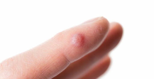 Mụn cóc là những u nhỏ, nốt sùi nhỏ tăng sinh của da. Nguyên nhân gây ra chính là virus HPV (Human Papillomavirus)