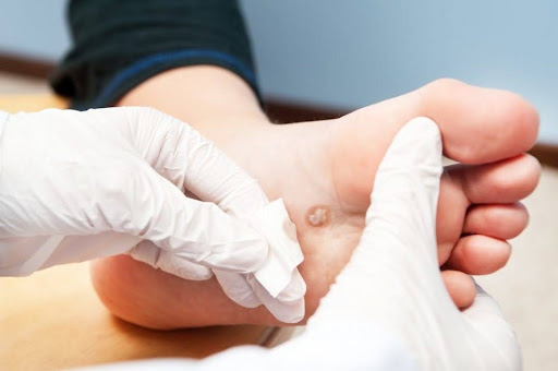 Bác sĩ da liễu có giải pháp cho vấn đề bị mụn cóc như thế nào?