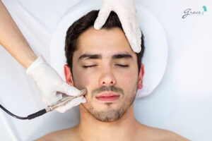 Mài da vi điểm giúp trị mụn thâm cho nam giới, làm mờ vết thâm mụn và ngừa hình thành sẹo mụn cho nam giới nhờ tẩy tế bào chết - trị thâm mụn bằng mài da vi điểm