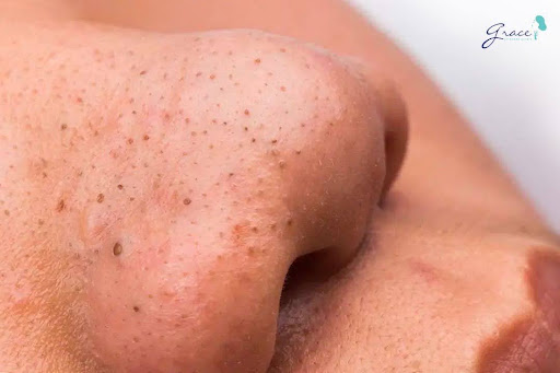 Mụn đầu đen là những nốt nhỏ có đầu màu đen sậm nổi trên bề mặt da