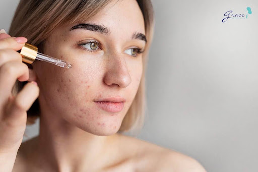 Các sản phẩm có chứa benzoyl peroxide, axit salicylic hoặc Vitamin A là phương pháp trị mụn cám có thể hiệu quả trong việc điều trị