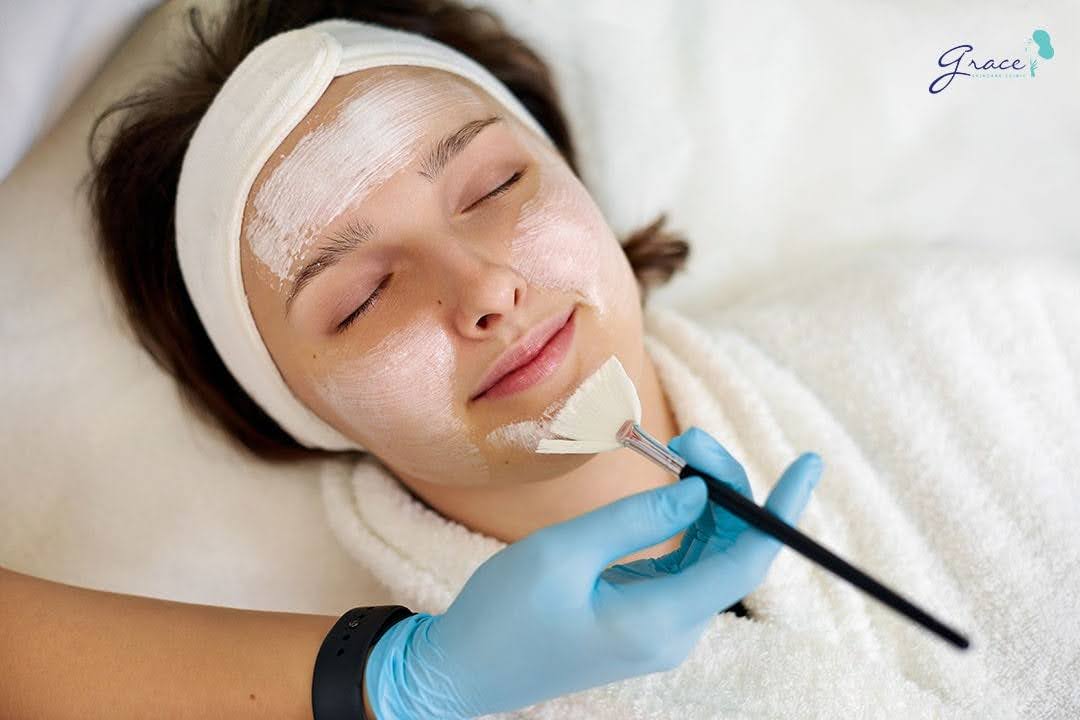 Peel da hóa học hỗ trợ loại bỏ các chất gây tắc nghẽn và loại bỏ các tế bào da chết, nguyên nhân gây ra mụn cám, giúp trị mụn cám hiệu quả
