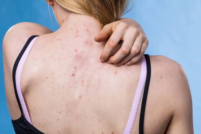 Gợi ý cách trị mụn lưng chuẩn y khoa theo Bác sĩ Da liễu