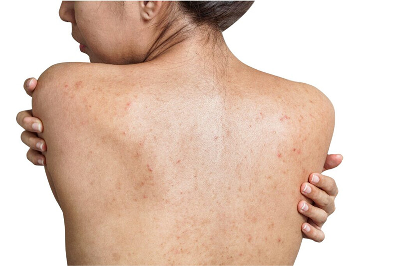 Mụn lưng là một tình trạng da liễu cực kỳ phổ biến, xuất hiện ở cả nam lẫn nữ và thuộc mọi lứa tuổi