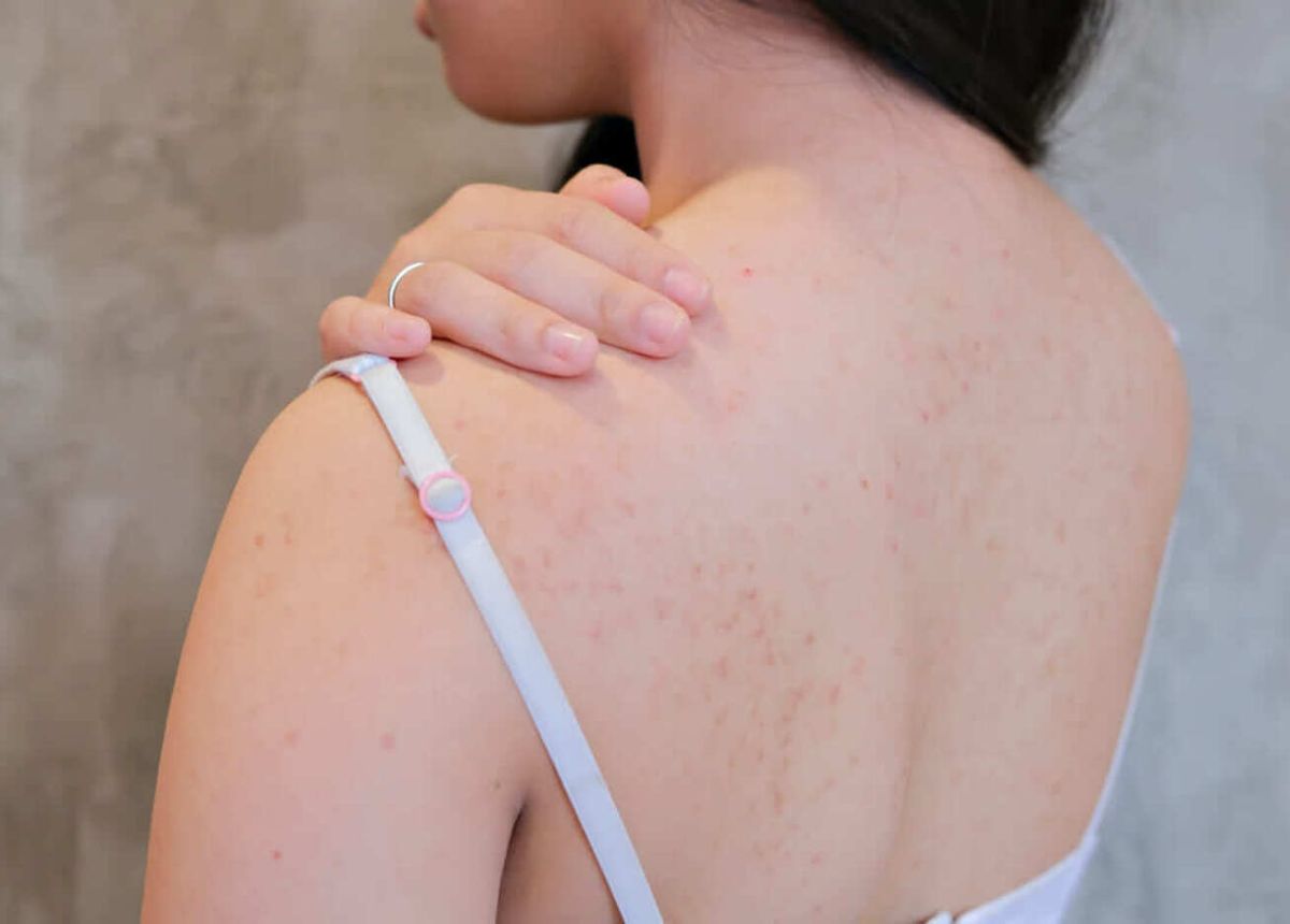 Bạn có thể có mụn chỉ ở vai và lưng trên hoặc chúng có thể phát triển khắp lưng, từ thâm mình đến thắt lưng