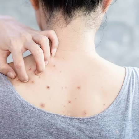 Mụn lưng là tình trạng các dạng mụn trứng cá, bao gồm mụn viêm, mụn sưng đỏ, mụn đầu trắng và mụn đầu đen, xuất hiện và phát triển tập trung ở vùng lưng