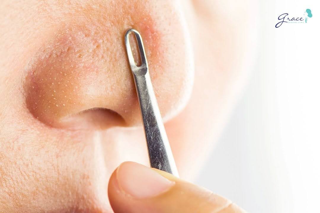Lấy nhân mụn có tốt không? Ý kiến từ Bác sĩ Da liễu