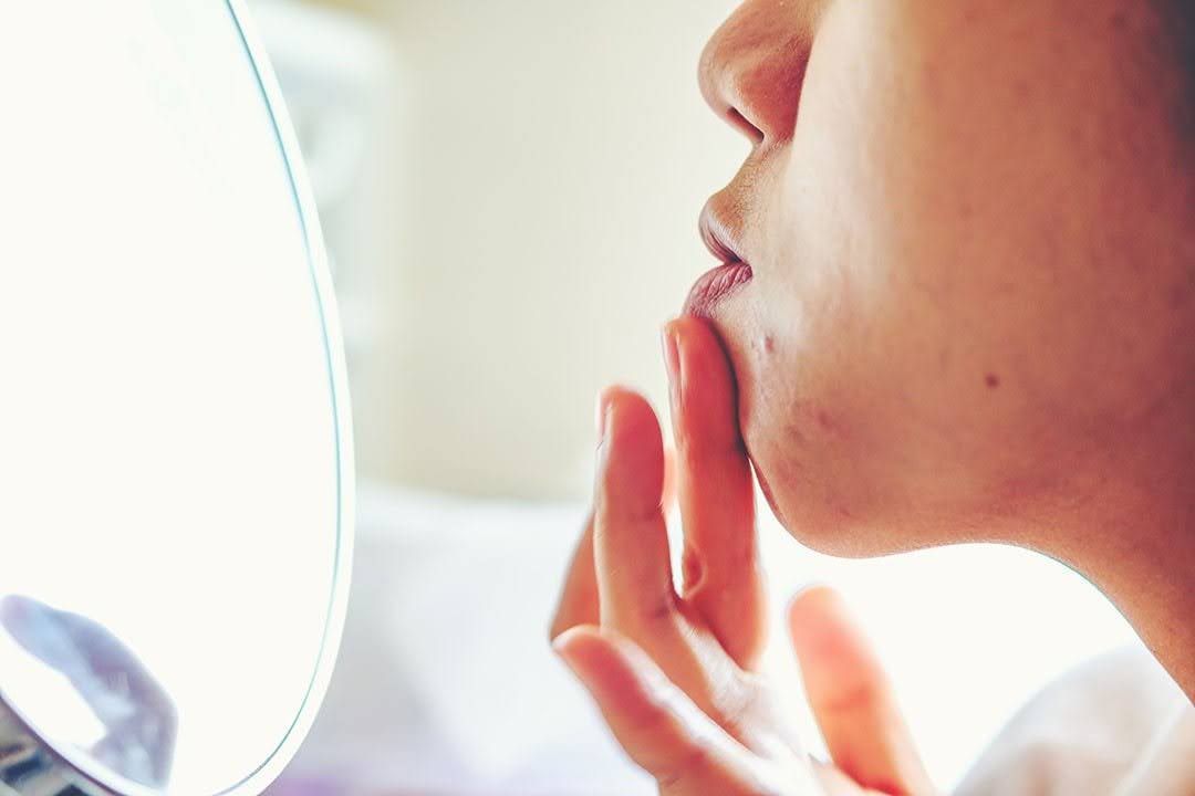Mụn ẩn ở mặt là mụn phát triển bên dưới da, mụn ẩn không thể nhìn thấy bằng mắt thường và gây mất thẩm mỹ